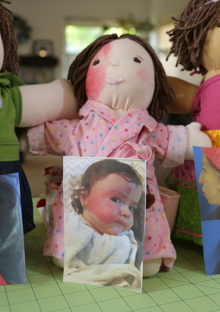 A doll created for Andrea, pictured, mimics her port-wine stain birthmark.